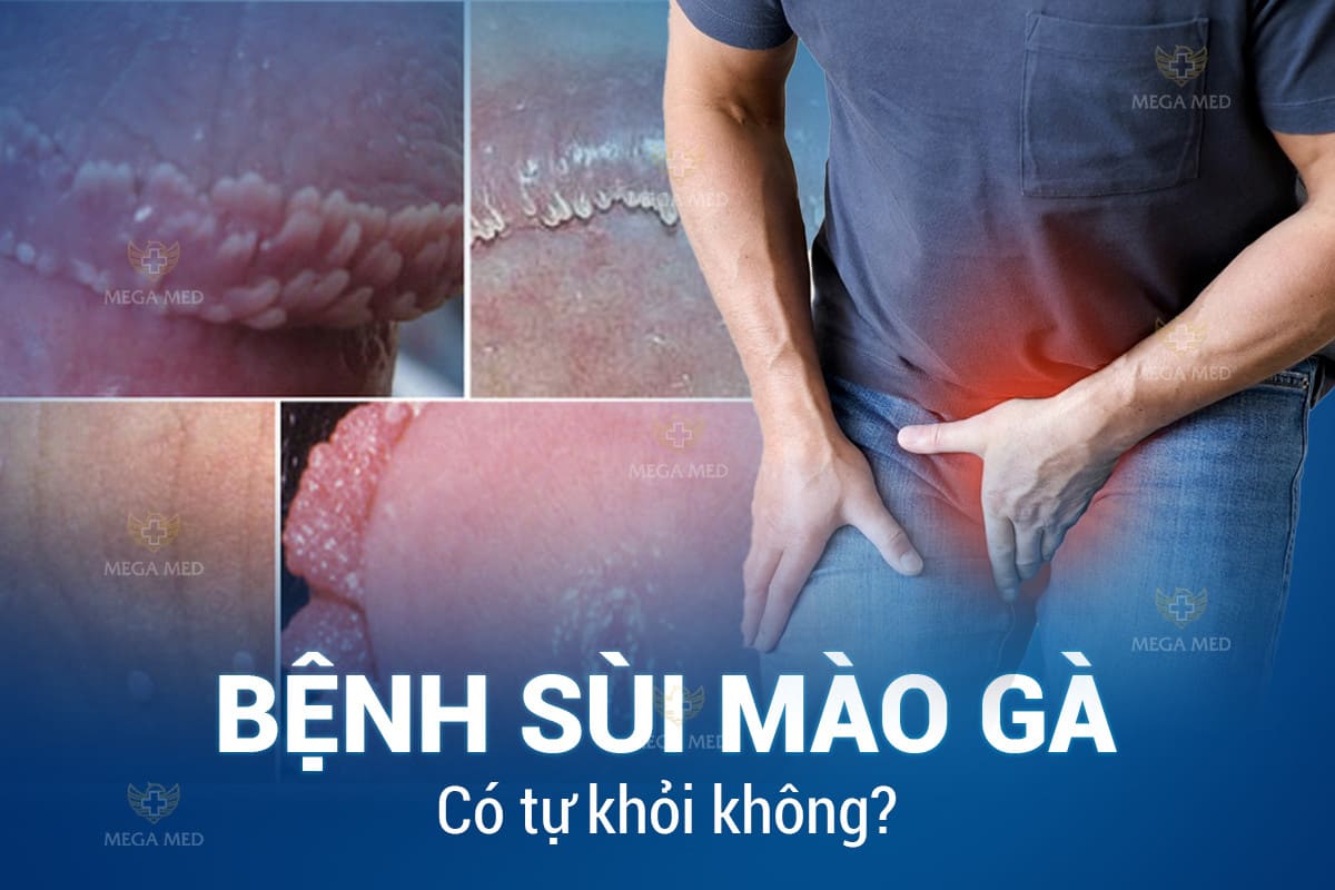 Sùi mào gà có tự khỏi không